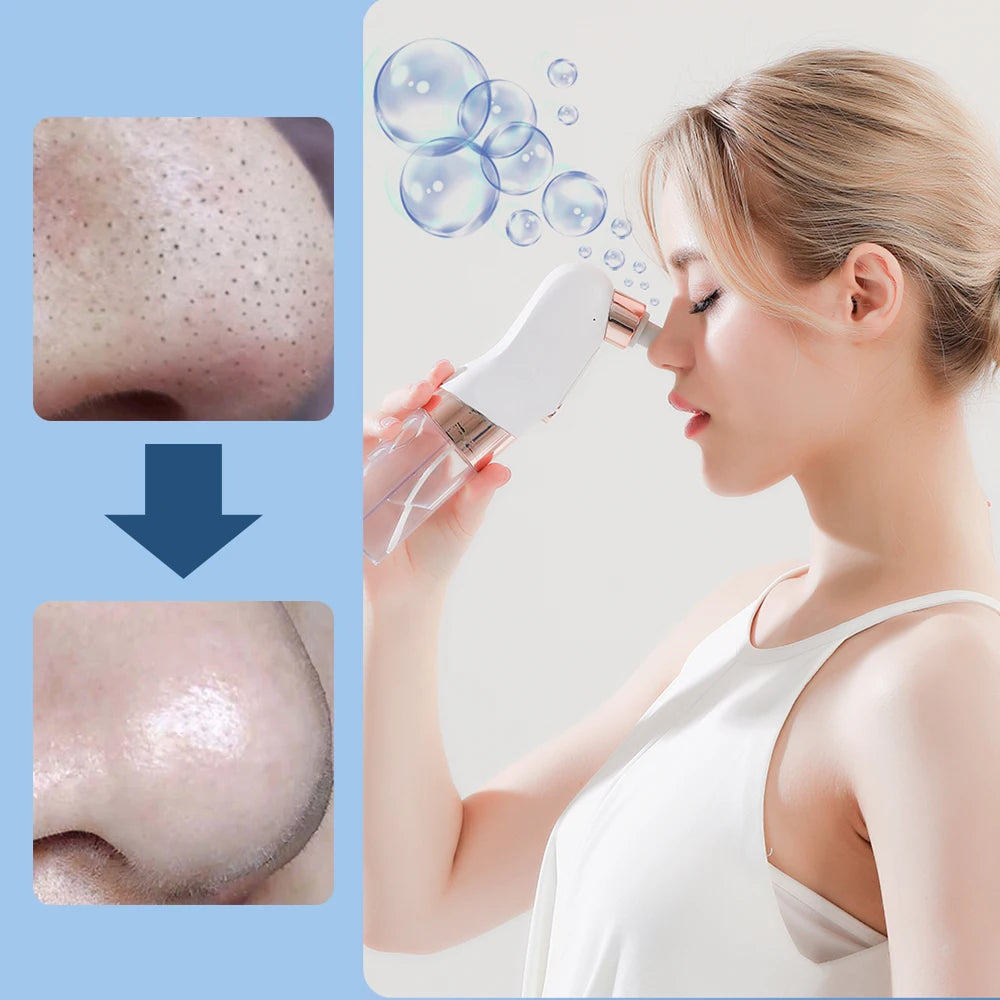 Vacuum Blackhead Remover – 3 Suction Levels | Bubble Water Infusion | USB Rechargeable
